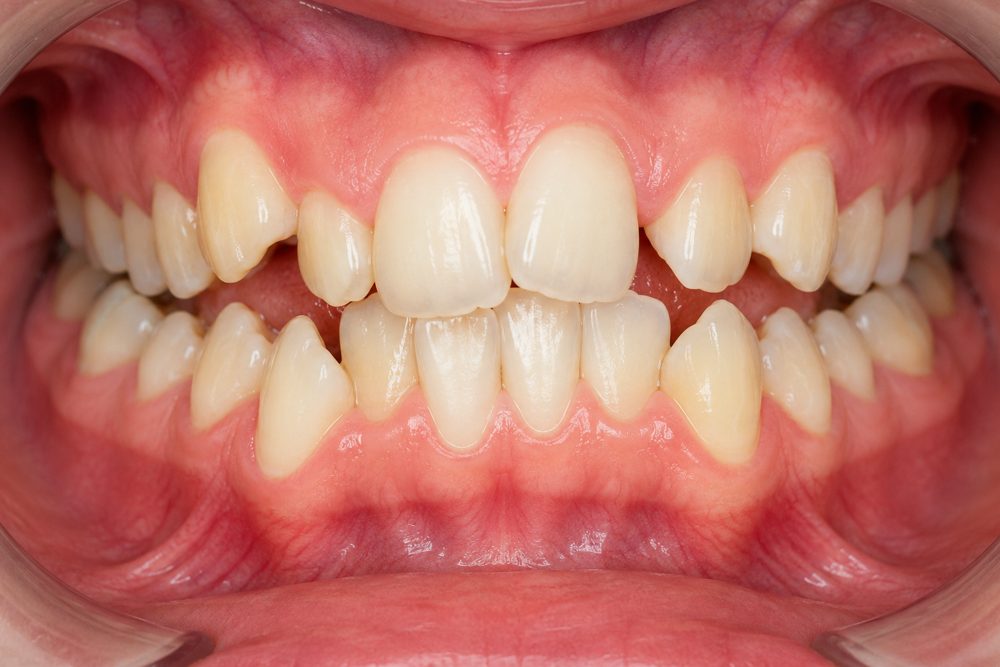Crowded or Overlapping Teeth — braces for teeth treatment at Floss-it, dental braces near me in Whitefield