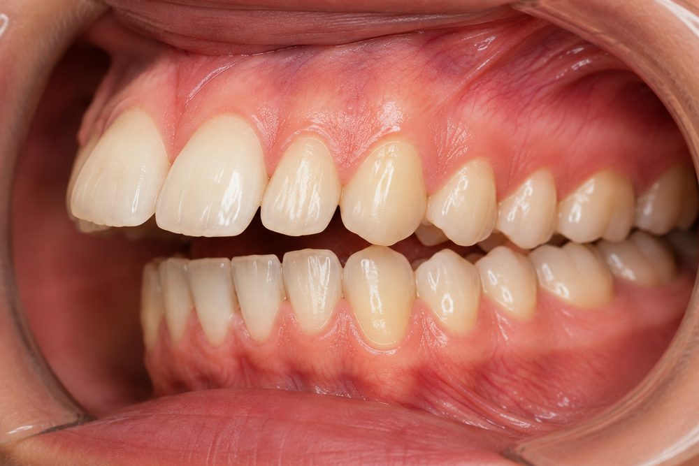 Protruding Front Teeth — braces for teeth treatment at Floss-it, dental braces near me in Whitefield