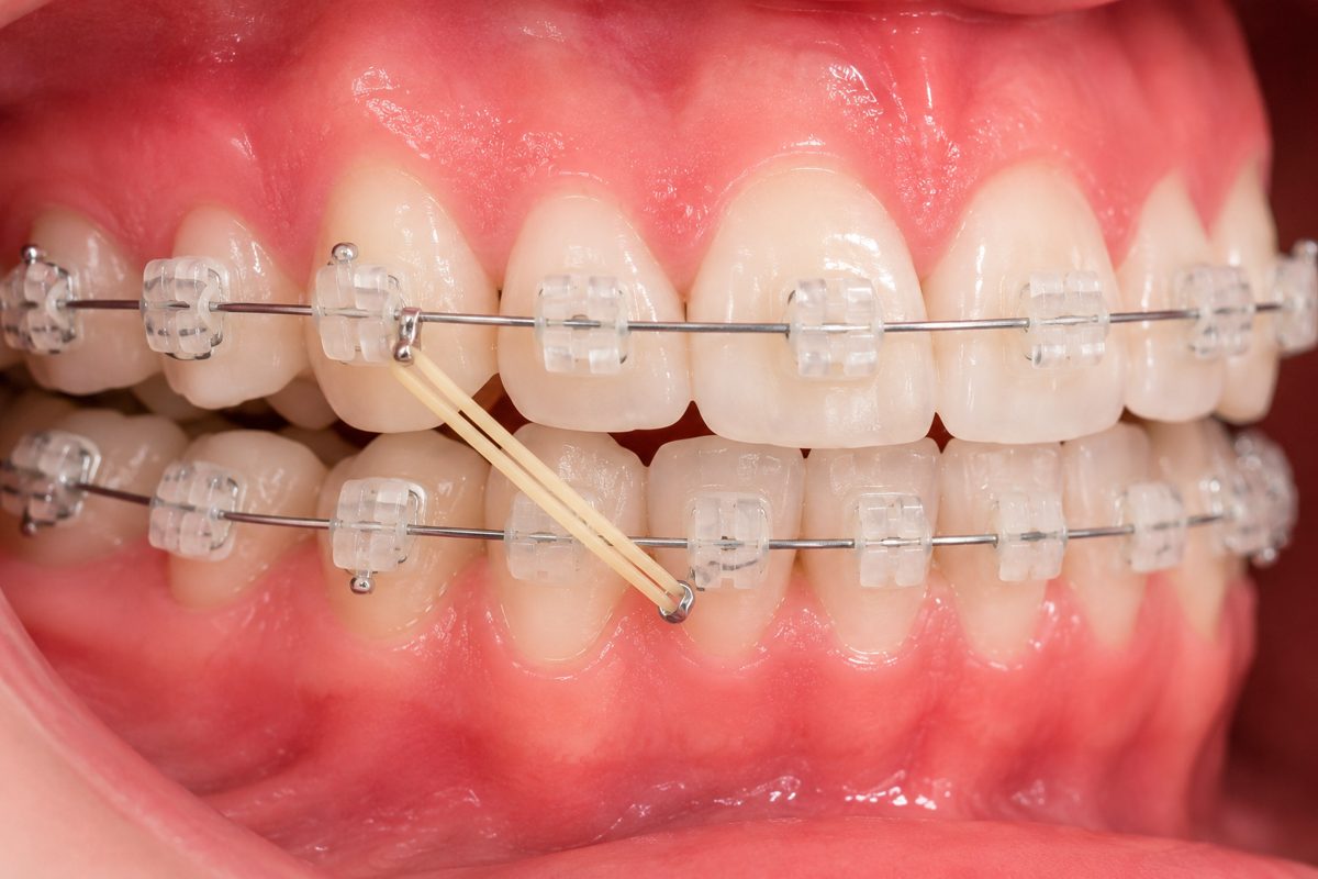 Ceramic Braces — braces for teeth at Floss-it Dental Clinic, dental braces near me in Whitefield