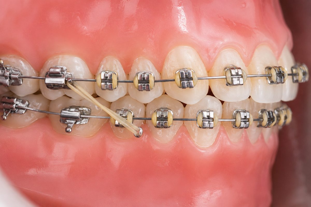 Traditional Metal Braces — braces for teeth at Floss-it Dental Clinic, dental braces near me in Whitefield